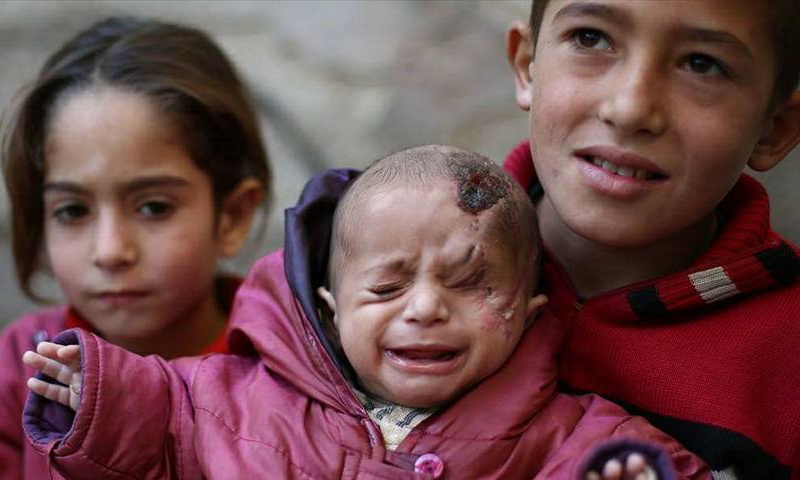 تزايد عدد الأطفال الذين تعرضوا لإصابات حربية شديدة في الغوطة